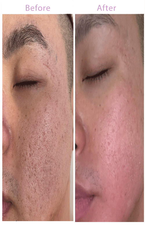 acne-scar-before-and-after-1-image