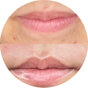 elizabeth-lip-flip-before-after-avatar