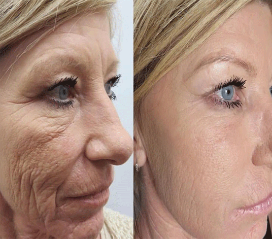 full-face-fibroblast-before-and-after-1-image