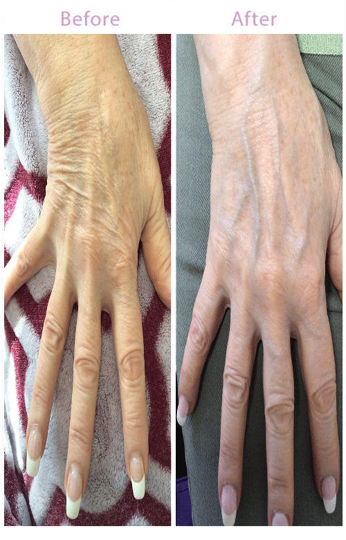 hand-rejuvenation-before-and-after-1-image