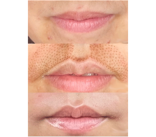 lip-flip-before-and-after-1-image