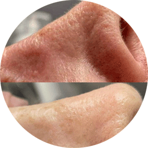 tillie-nose-resurface-testimonial-before-after-avatar
