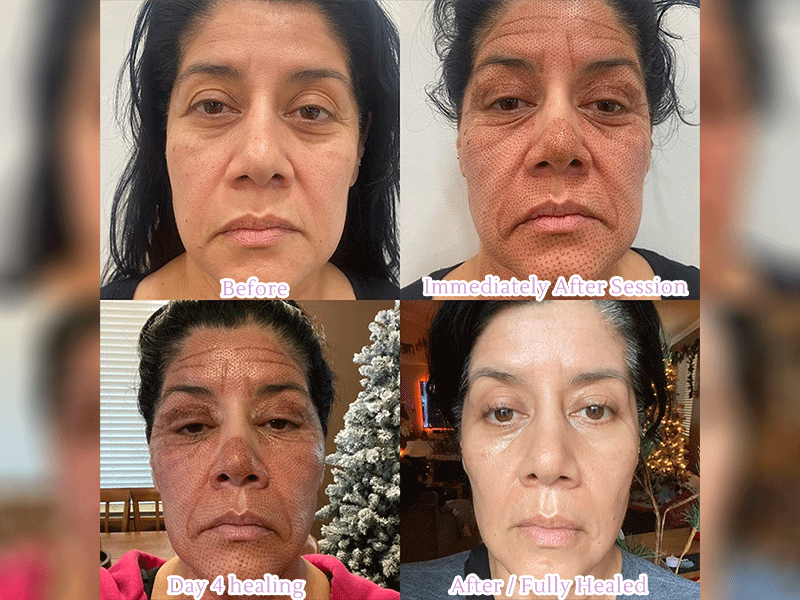full-face-fibroblast-before-and-after-3-image