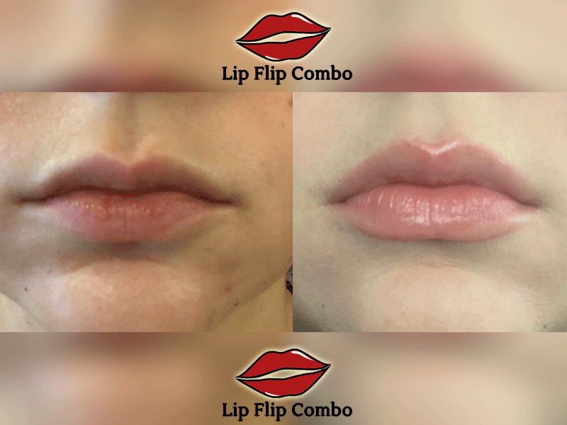 lip-flip-before-and-after-2-image