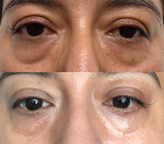 plasma-eye-lift-before-and-after-1-image