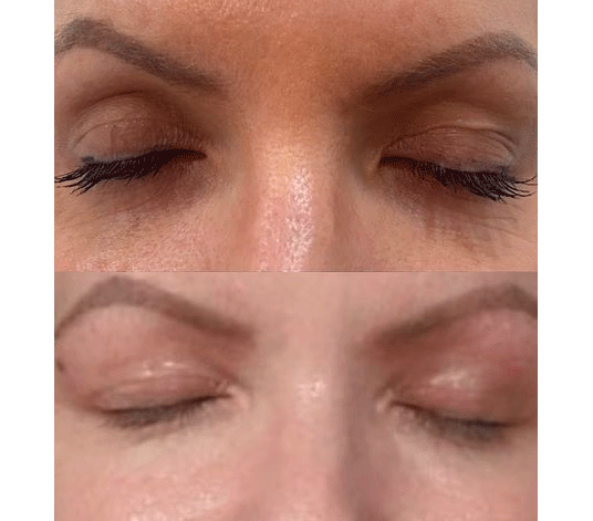 plasma-eye-lift-before-and-after-2-image