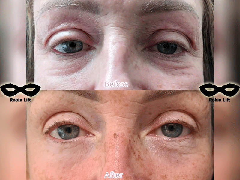 plasma-eye-lift-before-and-after-3-image